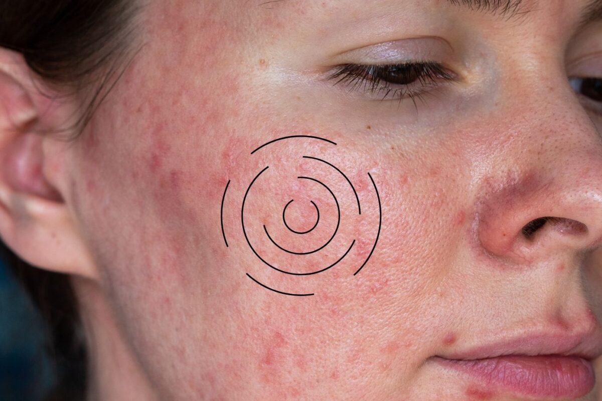 Understanding Acne vs. Rosacea