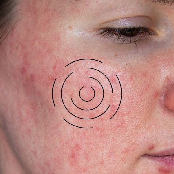 Understanding Acne vs. Rosacea