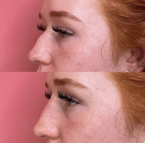 Non-Surgical Nose Job